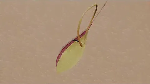 Suture Techniques - Subcuticular Running Suture