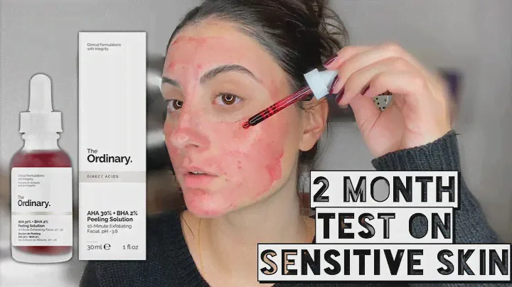 THE ORDINARY AHA 30% + BHA 2% PEELING SOLUTION ON ACNE PRONE, SENSITIVE SKIN | 2 Month Test
