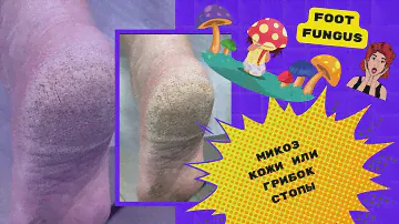 Cleaning the foot fungus. Зачистка грибка стопы.