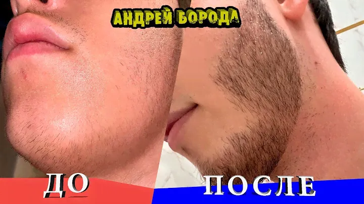 Зачем Роллер для Бороды / Минокс До и После / Андрей Борода / Выпуск № 14 "Как отрастить бороду"