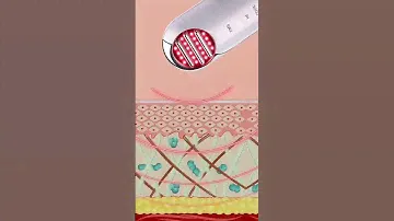 Как повысить упругость кожи и улучшить рельеф? Рассказываем про функцию RF прибора Splando